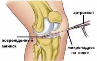 Травмы мениска коленного сустава: лечение без операции в домашних условиях, группы риска и виды повреждений