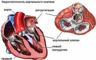 Аортальная регургитация 2 степени что это такое