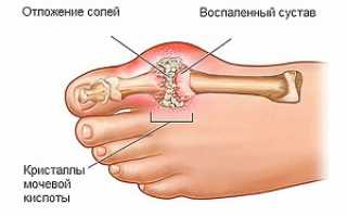 Основные причины отложения солей в стопе и лечение медикаментами, народными средствами, при помощи физиопроцедур и специальной диеты