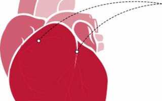 Стентирование при остром инфаркте миокарда