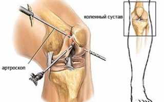 Современный метод диагностики и лечения патологических изменений — артроскопия коленного сустава: что это такое и как проходит процедура