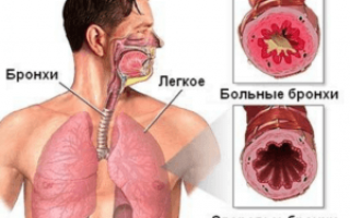 Причины постоянного першения в горле и покашливания