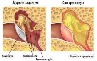 Скопление жидкости в ухе за барабанной перепонкой