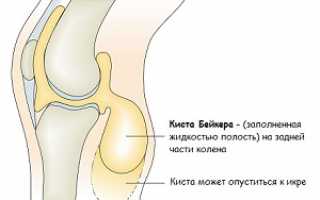 Шишка под коленом, заполненная синовиальной жидкостью — киста Бейкера коленного сустава: лечение в домашних условиях, полезная памятка пациенту