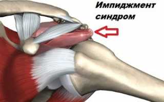 Эффективные способы лечения импиджмент — синдрома правого плечевого сустава и полезные советы пациентам