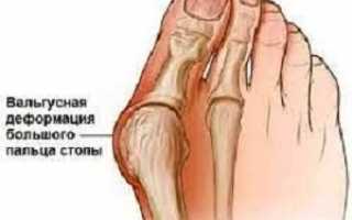 Консервативные методы лечения вальгусной деформации большого пальца стопы без операции и в каких случаях не обойтись без хирургического вмешательства