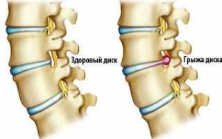 Признаки и симптомы межпозвонковой грыжи поясничного отдела: что делать в период обострения, правила дальнейшего лечения
