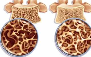 Что такое остеопения и как лечить деминерализацию костной ткани или начальную стадию остеопороза