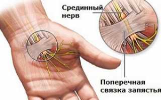 Карпальный или туннельный синдром запястья: основные причины возникновения, варианты терапии, полезная памятка пациентам