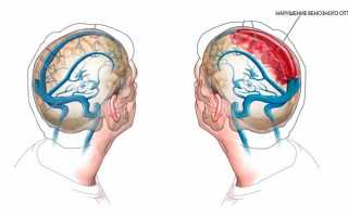 Как улучшить венозный отток крови из головы