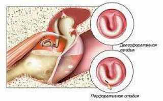 Симптомы и лечение воспаления барабанной перепонки