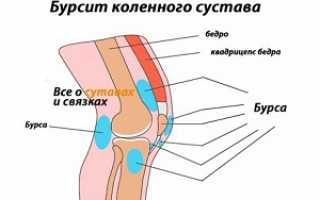 Воспаление синовиальной сумки или бурсит коленного сустава: симптомы и лечение, фото проявлений заболевания