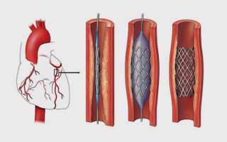 Хроническая коронарная недостаточность лечение