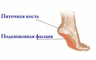 Что такое подошвенный фасциит: симптомы и лечение патологического процесса костно — мышечной системы