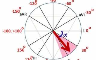 Экг отклонение электрической оси влево что это